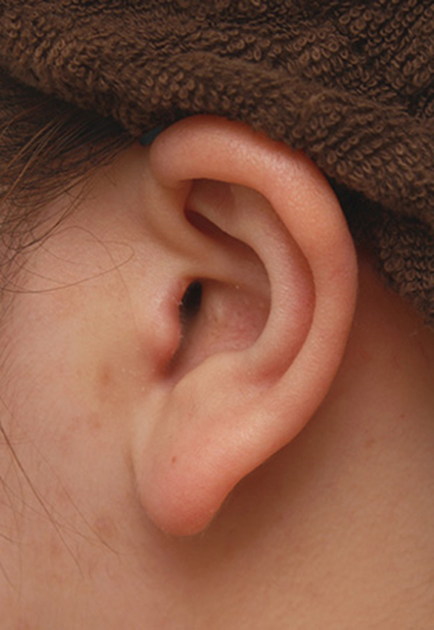 耳介軟骨移植（鼻先を出す）,団子鼻に対して鼻尖縮小はせず耳介軟骨移植のみを行った症例写真の術前術後画像,1週間後,mainpic_jikai08o.jpg