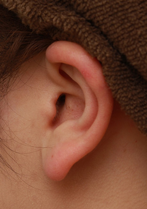 耳介軟骨移植（鼻先を出す）,団子鼻に対して鼻尖縮小はせず耳介軟骨移植のみを行った症例写真の術前術後画像,4ヶ月後,mainpic_jikai08p.jpg