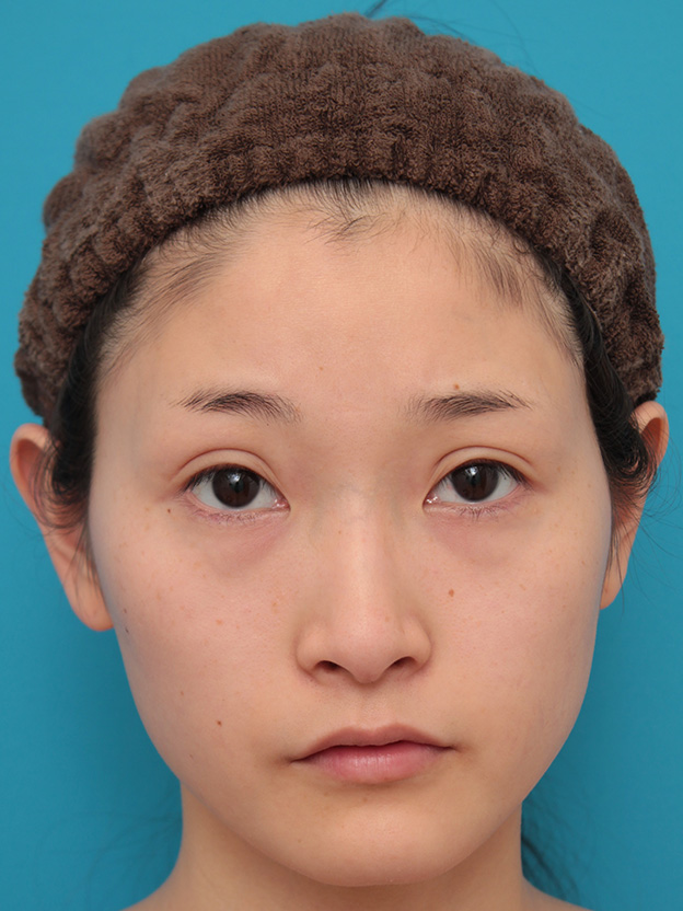 症例写真,二重まぶた全切開法とタレ目形成（グラマラスライン）を同時に行い、キツい目を優しい感じの印象に変えた症例写真の術前術後画像,2ヶ月後,目を開けた状態,mainpic_sekkai32h.jpg