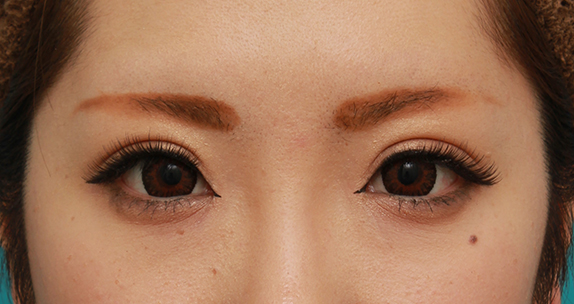 症例写真,目頭切開+眼瞼下垂手術で、アイラインを引いても奥二重のようにならない幅のある平行型二重を作った症例写真の術前術後画像,After（メイクあり）<br/>
（6ヶ月後）,