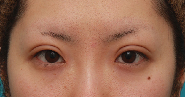 症例写真,目頭切開+眼瞼下垂手術で、アイラインを引いても奥二重のようにならない幅のある平行型二重を作った症例写真の術前術後画像,1ヶ月後,mainpic_megashira34d.jpg