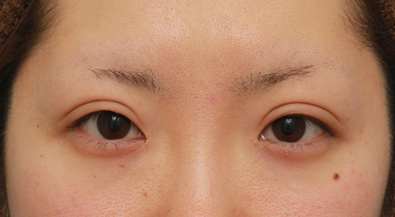 ボツリヌストキシン注射（目を下に大きくする、垂れ目形成）でグラマラスラインを作り、目を大きくした症例写真の術前術後画像,Before,ba_panda_botox03_b.jpg