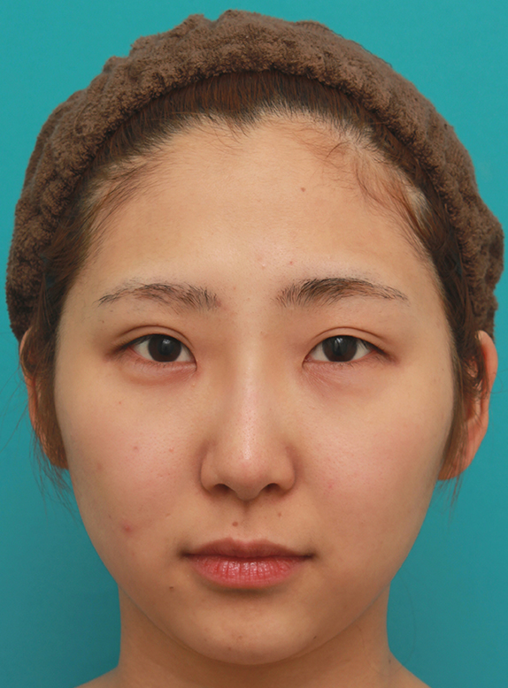 眉間から鼻にかけて長期持続型ヒアルロン酸を注射し、綺麗に鼻筋を通した20代女性の症例写真,After（注射後1週間）,ba_ryubichusha54_a01.jpg