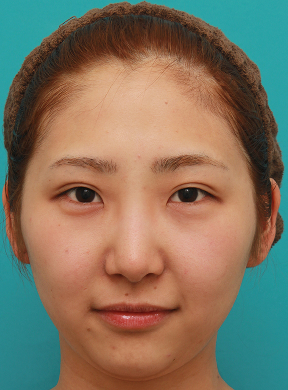 眉間から鼻にかけて長期持続型ヒアルロン酸を注射し、綺麗に鼻筋を通した20代女性の症例写真,Before,ba_ryubichusha54_b.jpg