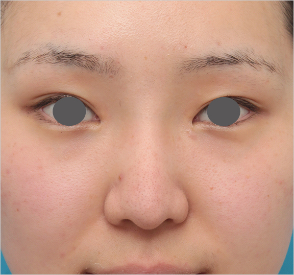 症例写真,鼻シリコンプロテーゼ+鼻先耳介軟骨移植の症例写真の腫れが引いていくダウンタイム経過画像,After（6ヶ月後）,ba_ryubi79_b.jpg