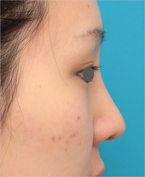症例写真,鼻シリコンプロテーゼ+鼻先耳介軟骨移植の症例写真の腫れが引いていくダウンタイム経過画像,After（6ヶ月後）,ba_ryubi81_b.jpg