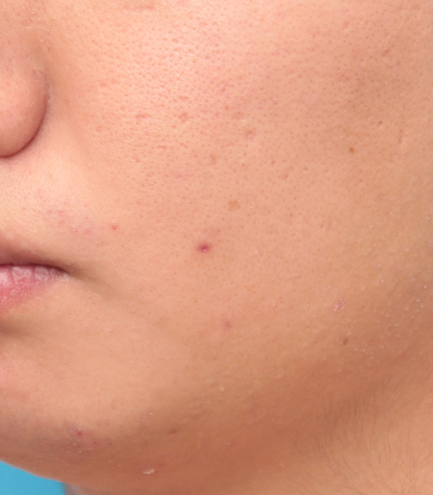症例写真,頬の黒子をCO2レーザーで分解除去した男性の症例写真の術前術後画像,1ヶ月後,mainpic_hokuro_ibo_aza09e.jpg