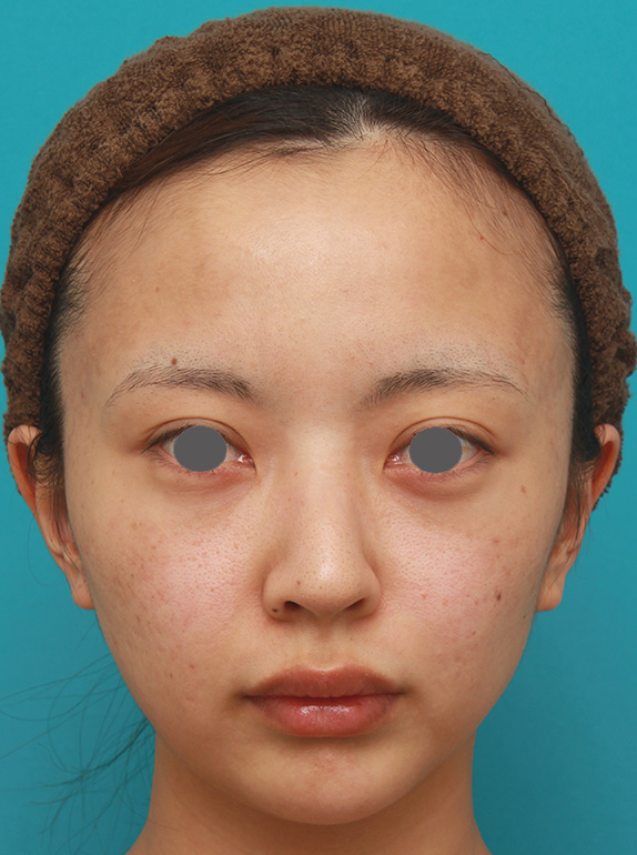 小顔専用脂肪溶解注射メソシェイプフェイスでほっそりすっきりした症例写真の術前術後画像,After（4回注射後2ヶ月後）,ba_meso_face06_a01.jpg