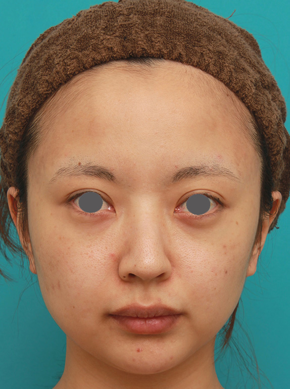 小顔専用脂肪溶解注射メソシェイプフェイスでほっそりすっきりした症例写真の術前術後画像,Before,ba_meso_face06_b.jpg