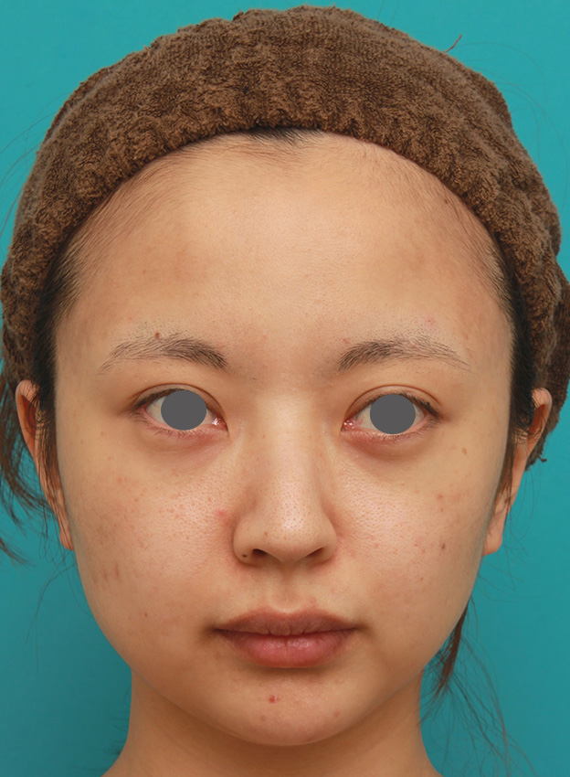 症例写真,小顔専用脂肪溶解注射メソシェイプフェイスでほっそりすっきりした症例写真の術前術後画像,治療前,mainpic_meso_face03a.jpg