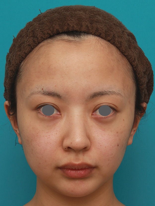 症例写真,小顔専用脂肪溶解注射メソシェイプフェイスでほっそりすっきりした症例写真の術前術後画像,1回目注射後1ヶ月,mainpic_meso_face03c.jpg
