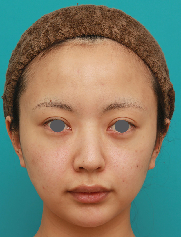 症例写真,小顔専用脂肪溶解注射メソシェイプフェイスでほっそりすっきりした症例写真の術前術後画像,2回目注射後1ヶ月,mainpic_meso_face03d.jpg
