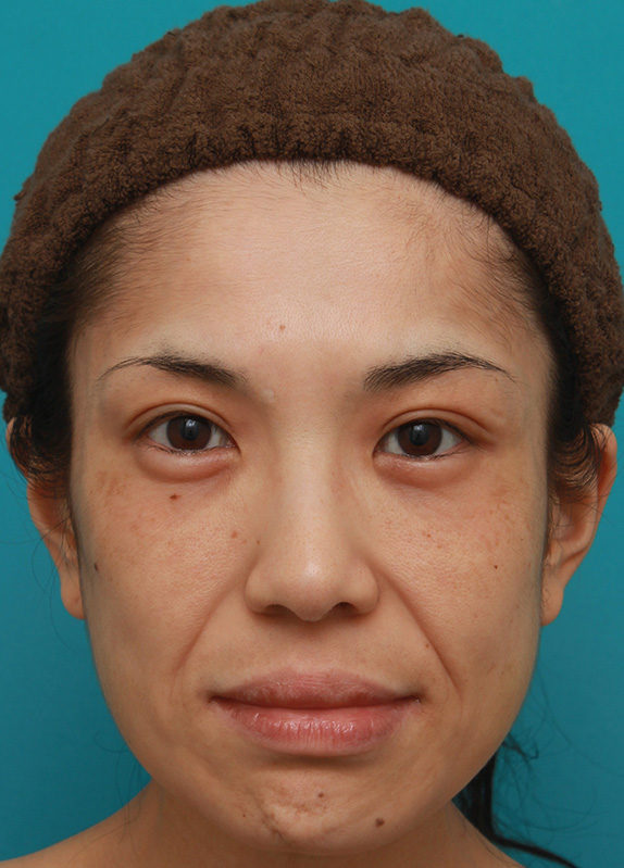 症例写真,ミディアムフェイスリフトで頬のたるみを改善し、法令線が浅くなった30代女性の症例写真,Before,ba_mediumlift006_b01.jpg