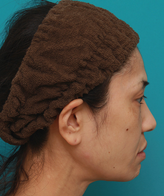 症例写真,ミディアムフェイスリフトで頬のたるみを改善し、法令線が浅くなった30代女性の症例写真,Before,ba_mediumlift006_b02.jpg