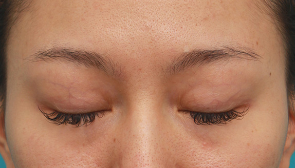 症例写真,二重まぶたミニ切開法+眉下リフト（上眼瞼リフト）を同時に行った症例写真の術前術後画像,Before,ba_jougankenlift009_b02.jpg