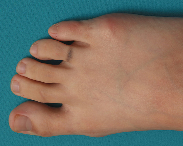 症例写真,自分で墨汁で入れた足の指の入れ墨をレーザーで除去した症例写真の術前術後画像,1回目レーザー治療後2ヶ月,mainpic_irezumi030c.jpg