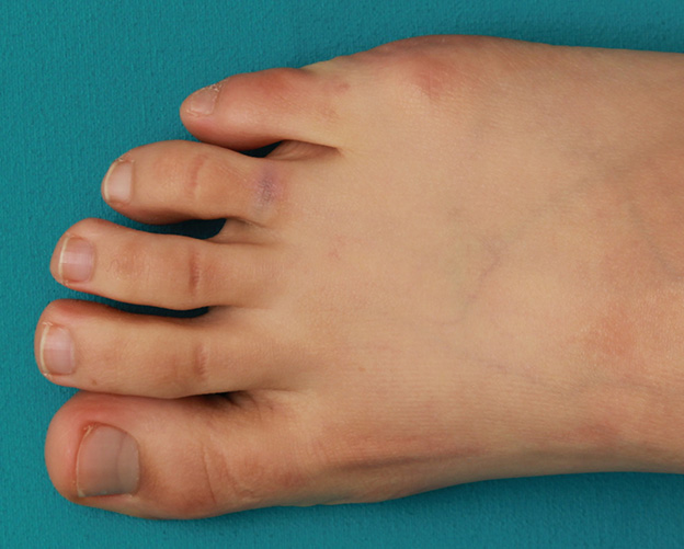 症例写真,自分で墨汁で入れた足の指の入れ墨をレーザーで除去した症例写真の術前術後画像,3回目レーザー治療後2ヶ月,mainpic_irezumi030e.jpg