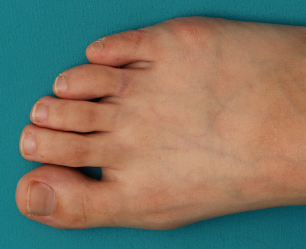 症例写真,自分で墨汁で入れた足の指の入れ墨をレーザーで除去した症例写真の術前術後画像,4回目レーザー治療後2ヶ月,mainpic_irezumi030f.jpg