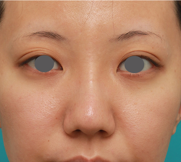 症例写真,凹凸のない平らな顔に長期持続型ヒアルロン酸を注射し、鼻筋を通した症例　術前術後画像,After（1ヶ月後）,ba_ryubi2027_b01.jpg