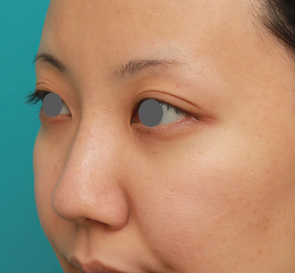 症例写真,凹凸のない平らな顔に長期持続型ヒアルロン酸を注射し、鼻筋を通した術前術後画像,After（1ヶ月後）,ba_ryubi2027_b02.jpg