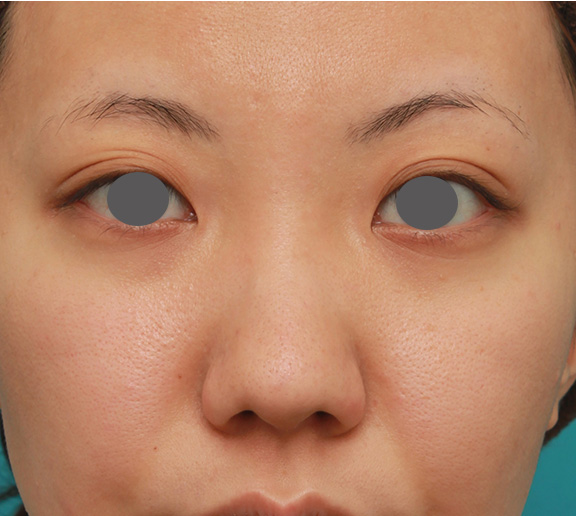 症例写真,凹凸のない平らな顔に長期持続型ヒアルロン酸を注射し、鼻筋を通した症例　術前術後画像,Before,ba_ryubi2027_b01.jpg
