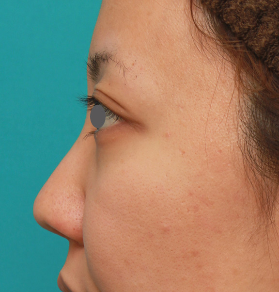 症例写真,凹凸のない平らな顔に長期持続型ヒアルロン酸を注射し、鼻筋を通した症例　術前術後画像,Before,ba_ryubi2027_b03.jpg