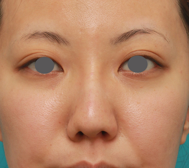 症例写真,凹凸のない平らな顔に長期持続型ヒアルロン酸を注射し、鼻筋を通した術前術後画像,注射直後,mainpic_ryubi2027b.jpg