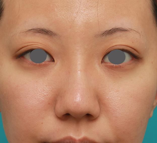 症例写真,凹凸のない平らな顔に長期持続型ヒアルロン酸を注射し、鼻筋を通した術前術後画像,1ヶ月後,mainpic_ryubi2027d.jpg