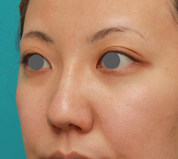 症例写真,凹凸のない平らな顔に長期持続型ヒアルロン酸を注射し、鼻筋を通した術前術後画像,注射直後,mainpic_ryubi2027f.jpg