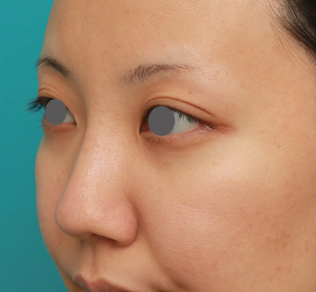 症例写真,凹凸のない平らな顔に長期持続型ヒアルロン酸を注射し、鼻筋を通した術前術後画像,1ヶ月後,mainpic_ryubi2027h.jpg