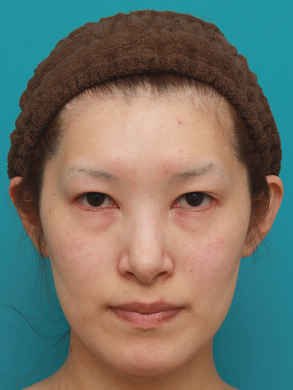 目尻切開+タレ目形成（グラマラスライン）で外斜視気味の目を改善させた症例写真の術前術後画像,After（6ヶ月後）,ba_panda016_a01.jpg