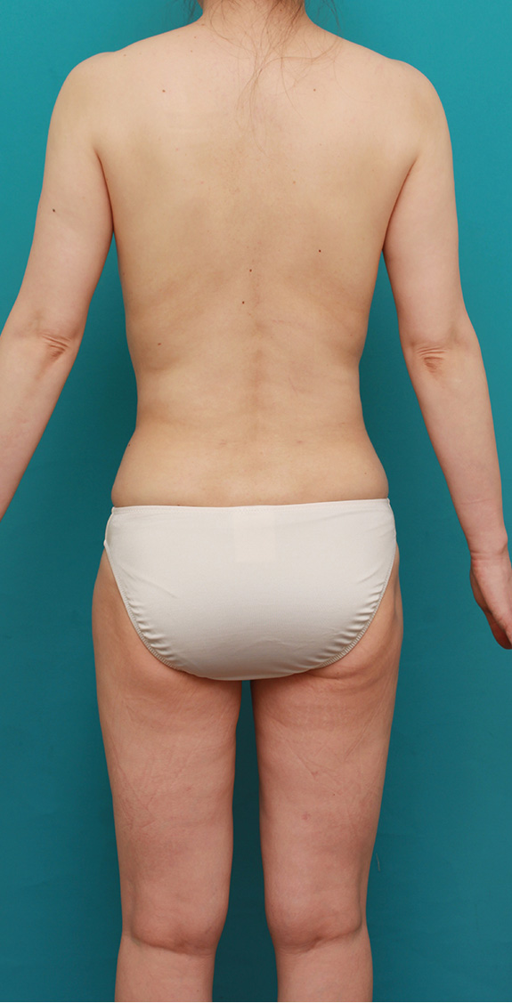 症例写真,生理食塩水豊胸バッグを除去し、同時にバスト脂肪注入した症例の術前術後画像,After(6ヶ月後),ba_prosthesis_removal002_b04.jpg