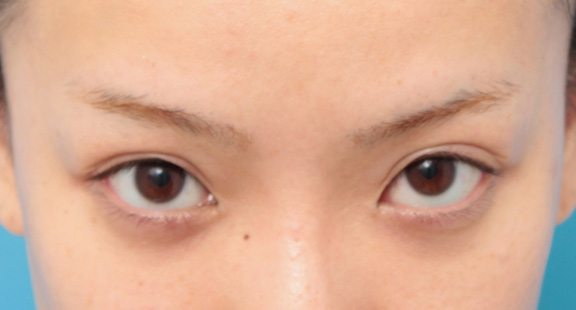症例写真,目頭切開、目尻切開、二重まぶた全切開法、目の下脂肪取りを同時に行った症例,After（9ヶ月後）<br/>
（顎を引いて睨んだ状態）,ba_sekkai044_b02.jpg