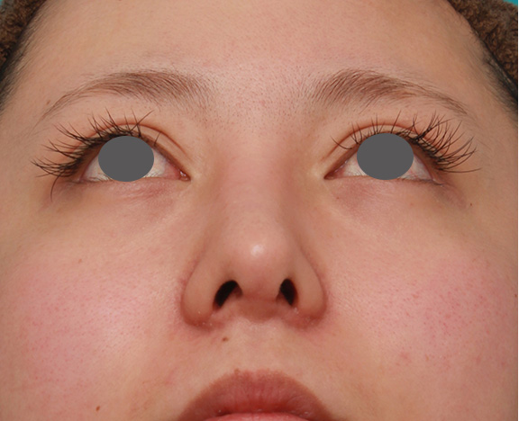 症例写真,他院で受けたゴアテックス+鼻中隔延長を自然な形に修正した症例の術前術後画像,After(修正手術前)
他院で手術をした3週間後,ba_nose_modify015_b02.jpg