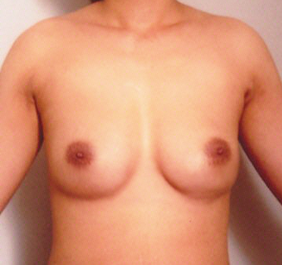症例写真,他院で受けた豊胸手術（シリコンプロテーゼ）の修正　大胸筋下から乳腺下へ入れ替え,After,ba_modify07_b.jpg