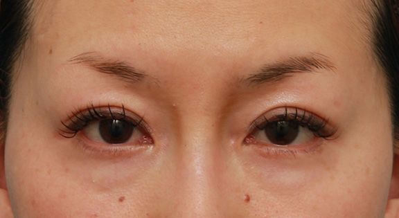 タレ目形成（グラマラスライン）をした30代後半女性の症例写真,After（6ヶ月後）,ba_panda017_a01.jpg