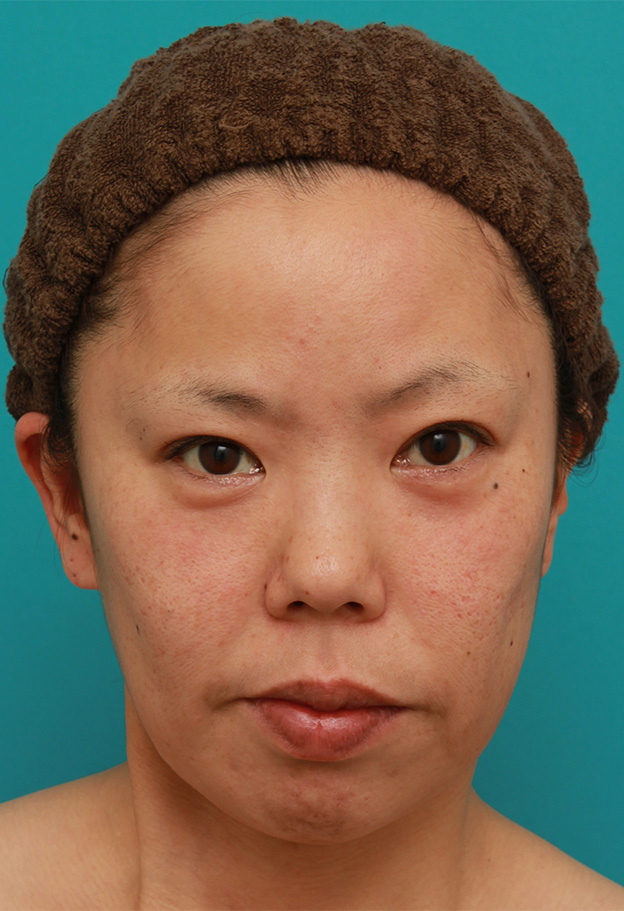 症例写真,ミディアムフェイスリフトを施した30代後半女性の症例写真,手術前,mainpic_mediumlift007a.jpg