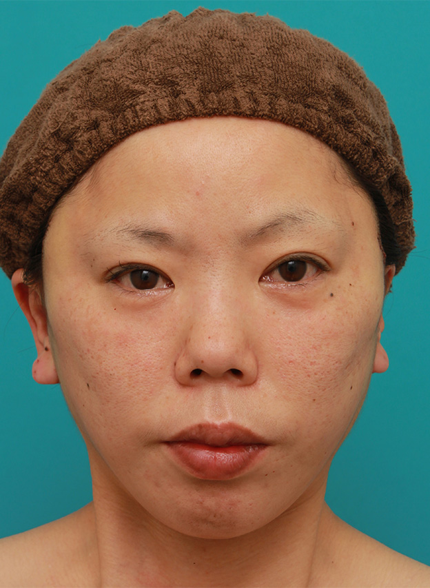 症例写真,ミディアムフェイスリフトを施した30代後半女性の症例写真,手術直後,mainpic_mediumlift007b.jpg