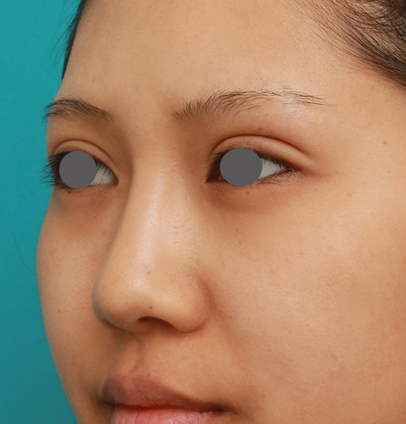 症例写真,鼻シリコンプロテーゼ+鼻先耳介軟骨移植+小鼻縮小を同時に行った症例写真,After（6ヶ月後）,ba_ryubi1034_b03.jpg