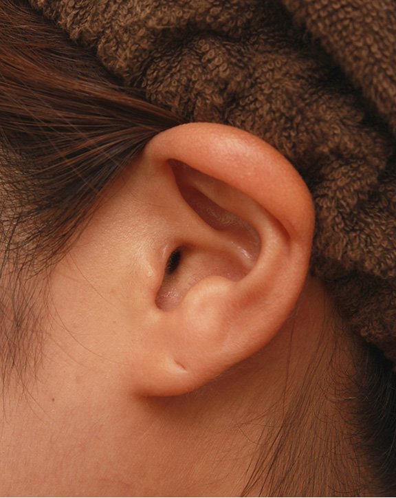 耳介軟骨移植（鼻先を出す）,鼻シリコンプロテーゼ+鼻先耳介軟骨移植+小鼻縮小を同時に行った症例写真,After（6ヶ月後）,ba_ryubi1034_b05.jpg
