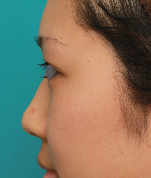 症例写真,鼻シリコンプロテーゼ+鼻先耳介軟骨移植+小鼻縮小を同時に行った症例写真,Before,ba_ryubi1034_b04.jpg