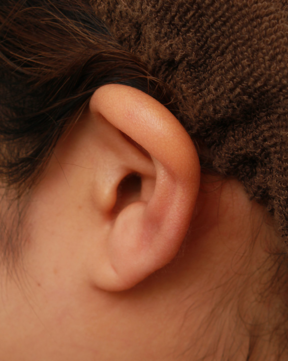 耳介軟骨移植（鼻先を出す）,鼻シリコンプロテーゼ+鼻先耳介軟骨移植+小鼻縮小を同時に行った症例写真,Before,ba_ryubi1034_b05.jpg