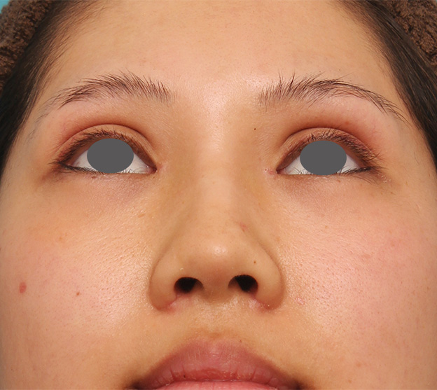 症例写真,鼻シリコンプロテーゼ+鼻先耳介軟骨移植+小鼻縮小を同時に行った症例写真,1週間後,mainpic_ryubi1034h.jpg