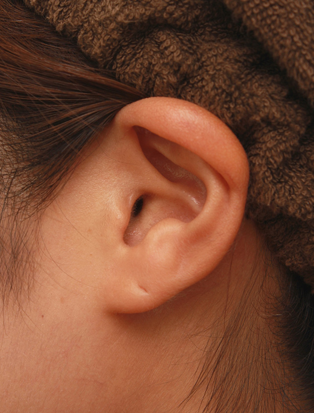 症例写真,鼻シリコンプロテーゼ+鼻先耳介軟骨移植+小鼻縮小を同時に行った症例写真,6ヶ月後の耳の状態,mainpic_ryubi1034o.jpg