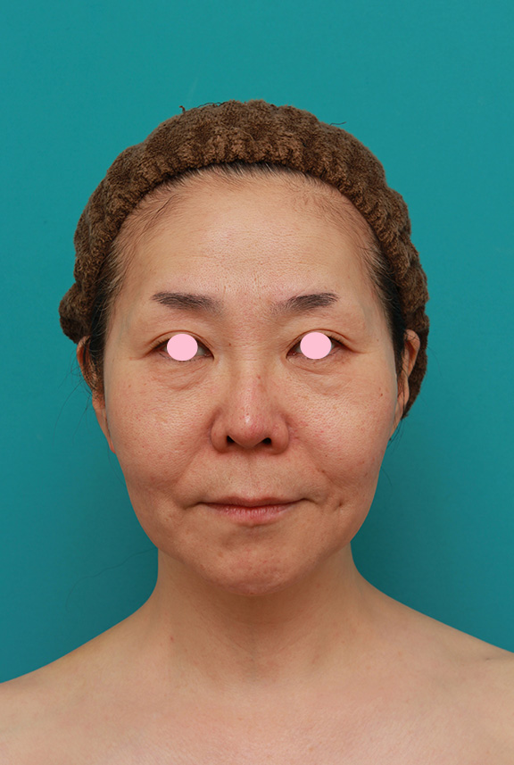 Vシェイプリフト（ヒアルロン酸注射）の症例 頬のたるみ、ゴルゴライン、法令線、マリオネットラインが気になる女性,Before,ba_v_shapelift001_b01.jpg