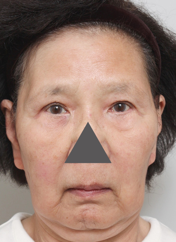 症例写真,70代女性の顔にサーマクールを行い、たるみが改善した症例写真,Before,ba_thermacool016_b01.jpg