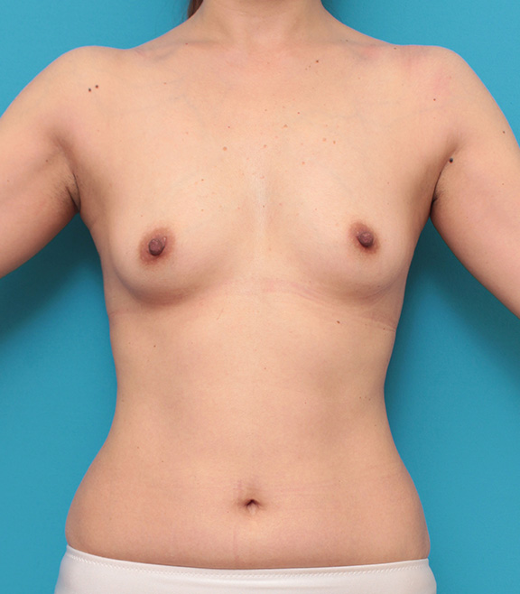 40代女性の細い身体の太もも全体から脂肪吸引し、バストに脂肪注入豊胸した症例写真,Before,ba_shibokyuin024_b01.jpg