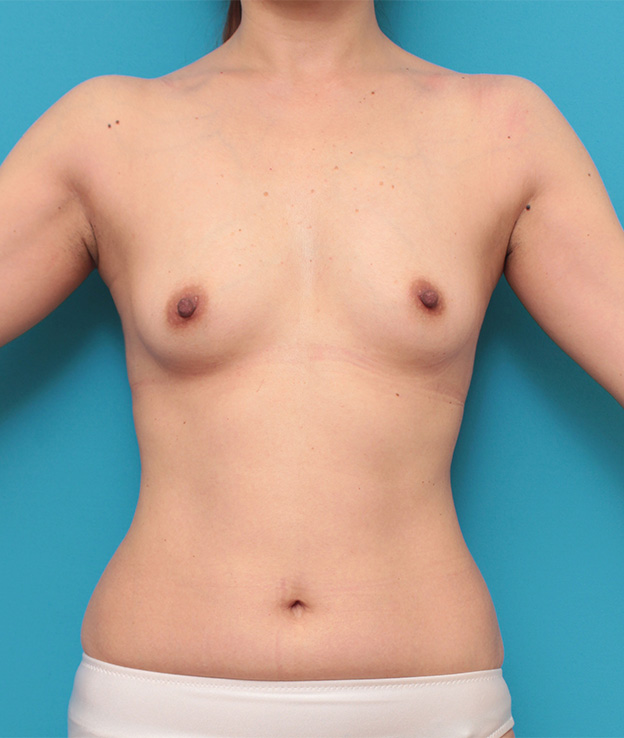 症例写真,40代女性の細い身体の太もも全体から脂肪吸引し、バストに脂肪注入豊胸した症例写真,手術前,mainpic_shibokyuin024a.jpg