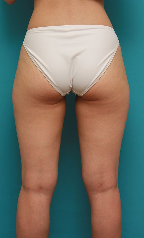 症例写真,イタリアン・メソシェイプ（イタリアンメソセラピー）・脂肪溶解注射で太もも~お尻にかけて全体的に細くした20代女性の症例写真,Before,ba_meso035_b05.jpg