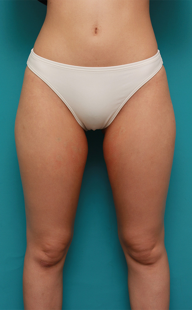 症例写真,イタリアン・メソシェイプ（イタリアンメソセラピー）・脂肪溶解注射で太もも~お尻にかけて全体的に細くした20代女性の症例写真,1回目注射直後,mainpic_meso035b.jpg